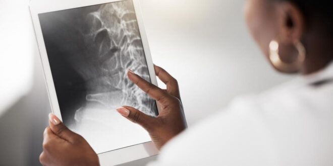 Di Amerika yang menua, osteoporosis adalah krisis kesehatan masyarakat yang membayangi