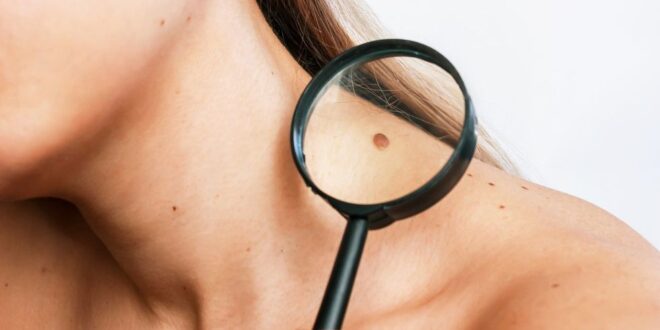 Melanoma 101 – Faktor Risiko, Diagnosis, Tahapan, dan Pengobatan
