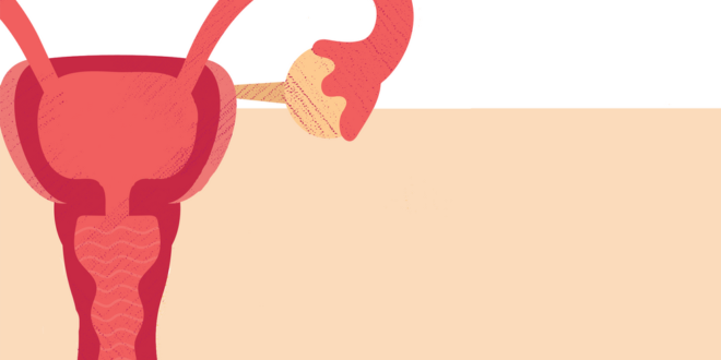 Ablasi frekuensi radio (RFA) adalah pilihan pengobatan untuk fibroid