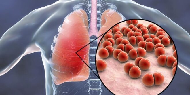 Apa itu penyakit pneumokokus?  Kesehatan perempuan