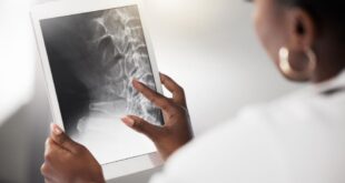 Di Amerika yang menua, osteoporosis adalah krisis kesehatan masyarakat yang membayangi