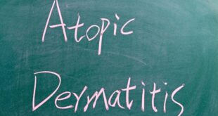 Hidup dengan Dermatitis Atopik (AD)