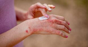 Bagaimana psoriasis mempengaruhi kesehatan umum Anda?