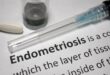 Fakta cepat: Apa yang perlu Anda ketahui tentang endometriosis