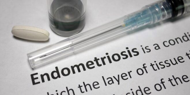 Fakta cepat: Apa yang perlu Anda ketahui tentang endometriosis