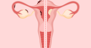 Apakah itu endometriosis atau kanker endometrium?