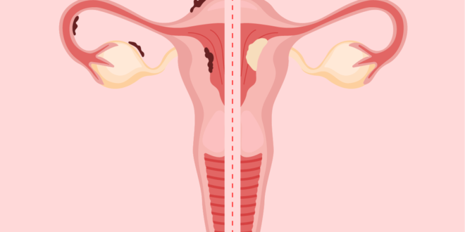 Apakah itu endometriosis atau kanker endometrium?