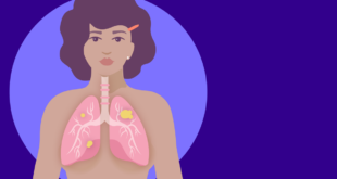 Wanita yang tidak pernah merokok bisa terkena kanker paru-paru