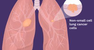 Kanker paru-paru non-sel kecil
